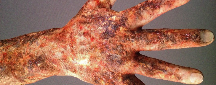 Iron Man 3 burn concept